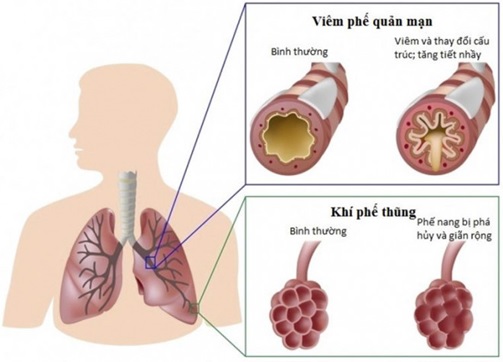 Bệnh hô hấp mạn tính và COVID-19